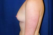 Breast Augmentation Before Photo by Bahram Ghaderi, MD, FACS; St. Charles, IL - Case 9391