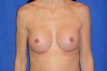 Breast Augmentation After Photo by Bahram Ghaderi, MD, FACS; St. Charles, IL - Case 9392