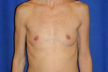 Breast Augmentation Before Photo by Bahram Ghaderi, MD, FACS; St. Charles, IL - Case 9392