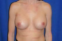 Breast Augmentation After Photo by Bahram Ghaderi, MD, FACS; St. Charles, IL - Case 9394