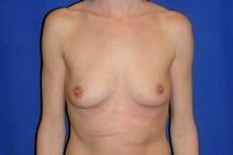 Breast Augmentation Before Photo by Bahram Ghaderi, MD, FACS; St. Charles, IL - Case 9394