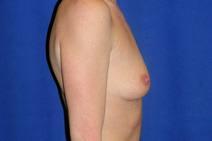 Breast Augmentation Before Photo by Bahram Ghaderi, MD, FACS; St. Charles, IL - Case 9394