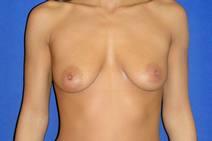 Breast Augmentation Before Photo by Bahram Ghaderi, MD, FACS; St. Charles, IL - Case 9395