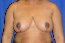 Breast Reduction After Photo by Bahram Ghaderi, MD, FACS; St. Charles, IL - Case 9401