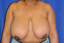 Breast Reduction Before Photo by Bahram Ghaderi, MD, FACS; St. Charles, IL - Case 9401