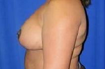 Breast Reduction After Photo by Bahram Ghaderi, MD, FACS; St. Charles, IL - Case 9401