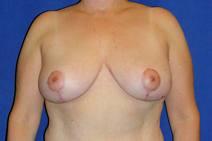 Breast Reduction After Photo by Bahram Ghaderi, MD, FACS; St. Charles, IL - Case 9403