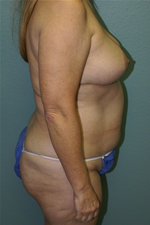 Liposuction Before Photo by Nir Binur, MD; Port Arthur, TX - Case 22916