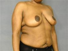 Breast Reduction After Photo by Ellen Janetzke, MD; Bloomfield Hills, MI - Case 25784