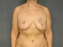 Breast Reduction After Photo by Ellen Janetzke, MD; Bloomfield Hills, MI - Case 25792