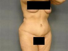 Body Contouring After Photo by Ellen Janetzke, MD; Bloomfield Hills, MI - Case 25793