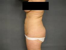 Liposuction After Photo by Ellen Janetzke, MD; Bloomfield Hills, MI - Case 25794