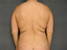 Liposuction After Photo by Ellen Janetzke, MD; Bloomfield Hills, MI - Case 25794