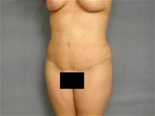 Tummy Tuck After Photo by Ellen Janetzke, MD; Bloomfield Hills, MI - Case 25796