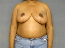 Breast Reduction After Photo by Ellen Janetzke, MD; Bloomfield Hills, MI - Case 25804