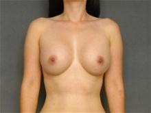 Breast Augmentation After Photo by Ellen Janetzke, MD; Bloomfield Hills, MI - Case 25805