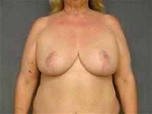 Breast Reduction After Photo by Ellen Janetzke, MD; Bloomfield Hills, MI - Case 25817