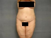 Body Contouring After Photo by Ellen Janetzke, MD; Bloomfield Hills, MI - Case 25818