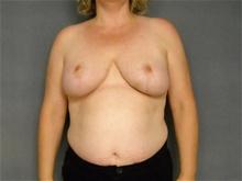 Breast Reduction After Photo by Ellen Janetzke, MD; Bloomfield Hills, MI - Case 25857