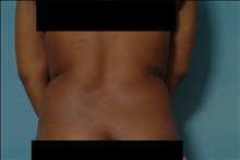 Liposuction Before Photo by Ellen Janetzke, MD; Bloomfield Hills, MI - Case 23658