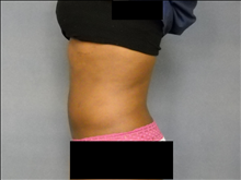 Liposuction After Photo by Ellen Janetzke, MD; Bloomfield Hills, MI - Case 23658