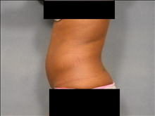 Liposuction Before Photo by Ellen Janetzke, MD; Bloomfield Hills, MI - Case 23658
