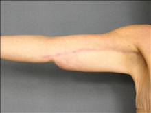 Arm Lift After Photo by Ellen Janetzke, MD; Bloomfield Hills, MI - Case 23836