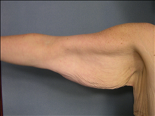Arm Lift Before Photo by Ellen Janetzke, MD; Bloomfield Hills, MI - Case 23836