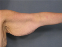 Arm Lift Before Photo by Ellen Janetzke, MD; Bloomfield Hills, MI - Case 23836