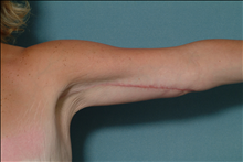 Arm Lift After Photo by Ellen Janetzke, MD; Bloomfield Hills, MI - Case 23837