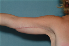 Arm Lift After Photo by Ellen Janetzke, MD; Bloomfield Hills, MI - Case 23837