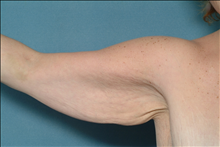 Arm Lift Before Photo by Ellen Janetzke, MD; Bloomfield Hills, MI - Case 23837