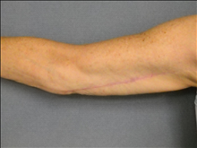 Arm Lift After Photo by Ellen Janetzke, MD; Bloomfield Hills, MI - Case 23838