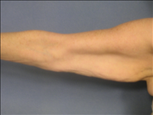 Arm Lift Before Photo by Ellen Janetzke, MD; Bloomfield Hills, MI - Case 23838