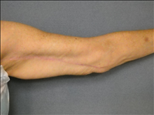 Arm Lift After Photo by Ellen Janetzke, MD; Bloomfield Hills, MI - Case 23838