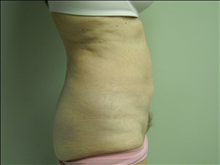 Liposuction After Photo by Ellen Janetzke, MD; Bloomfield Hills, MI - Case 23839