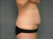 Liposuction Before Photo by Ellen Janetzke, MD; Bloomfield Hills, MI - Case 23839