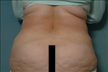 Liposuction After Photo by Ellen Janetzke, MD; Bloomfield Hills, MI - Case 23840