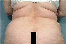 Liposuction Before Photo by Ellen Janetzke, MD; Bloomfield Hills, MI - Case 23840
