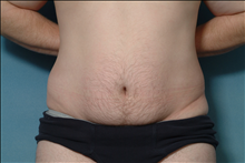 Liposuction After Photo by Ellen Janetzke, MD; Bloomfield Hills, MI - Case 23841