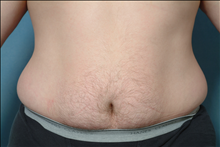 Liposuction Before Photo by Ellen Janetzke, MD; Bloomfield Hills, MI - Case 23841