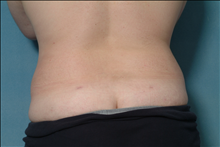 Liposuction After Photo by Ellen Janetzke, MD; Bloomfield Hills, MI - Case 23841