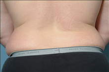 Liposuction Before Photo by Ellen Janetzke, MD; Bloomfield Hills, MI - Case 23841