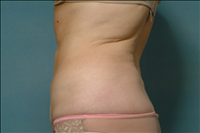 Liposuction After Photo by Ellen Janetzke, MD; Bloomfield Hills, MI - Case 23842