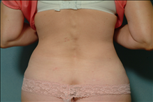 Liposuction After Photo by Ellen Janetzke, MD; Bloomfield Hills, MI - Case 23842