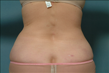 Liposuction Before Photo by Ellen Janetzke, MD; Bloomfield Hills, MI - Case 23842