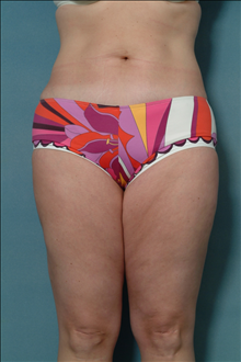 Liposuction After Photo by Ellen Janetzke, MD; Bloomfield Hills, MI - Case 23844