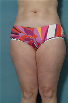 Liposuction Before Photo by Ellen Janetzke, MD; Bloomfield Hills, MI - Case 23844