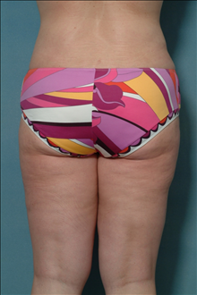 Liposuction After Photo by Ellen Janetzke, MD; Bloomfield Hills, MI - Case 23844