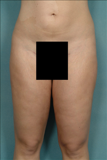 Liposuction After Photo by Ellen Janetzke, MD; Bloomfield Hills, MI - Case 23845